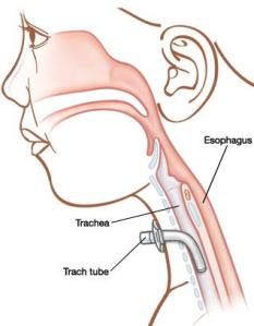 trach2